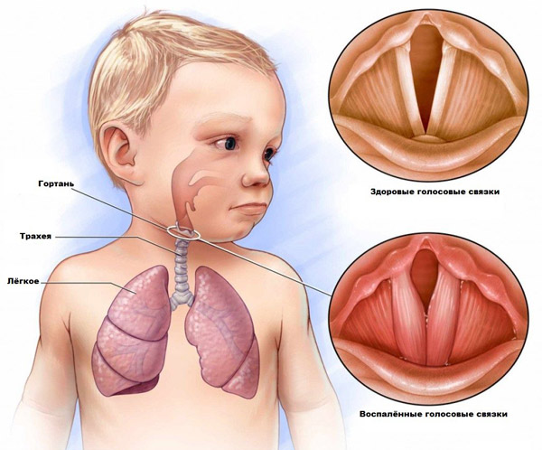 Ларингит (Laringitis) - причины, симптомы и лечение | Научно-медицинский портал