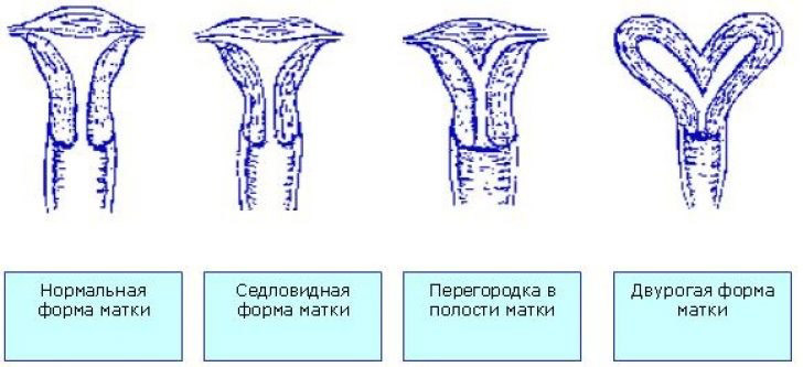 Что такое двурогая матка у женщин?