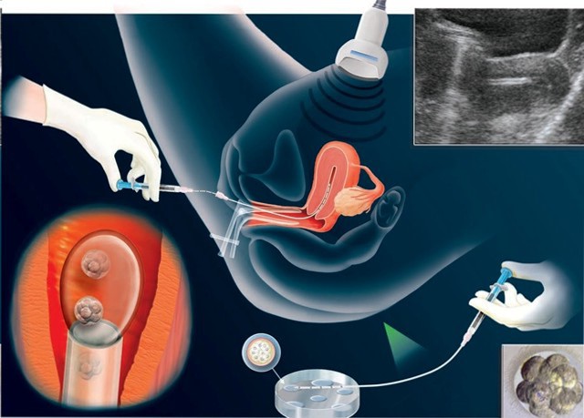 Рисунок 7. Перенос эмбрионов в полость матки