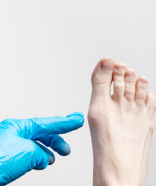 Причины и факторы риска деформации большого пальца стопы