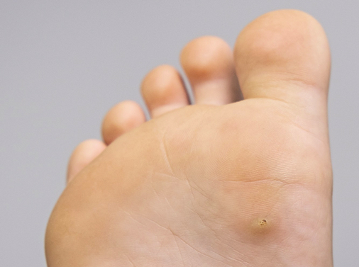 What are plantar warts?