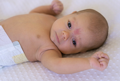 What is a hemangioma?