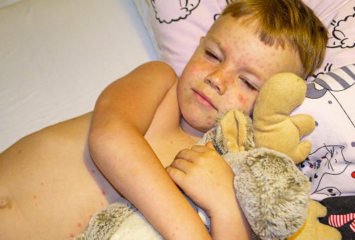 Классификация и стадии развития контагиозного моллюска