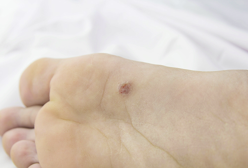 Общие сведения о бородавках у детей