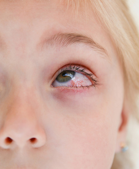 Причины и патогенез ячменя у ребенка
