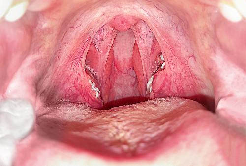 Granular pharyngitis