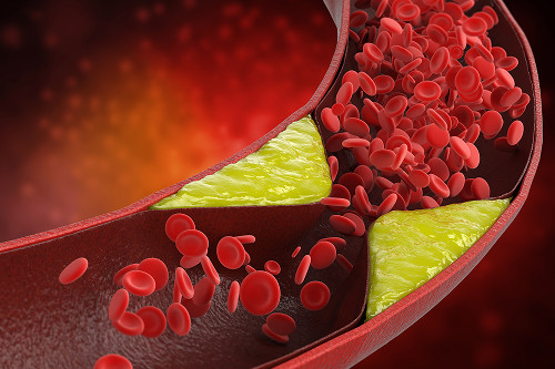 What is atherosclerosis?