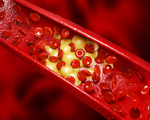 Stages of atherosclerosis development