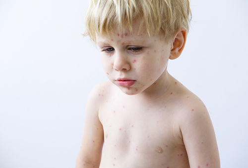 Что такое импетиго