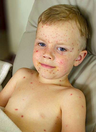 Классификация и стадии импетиго