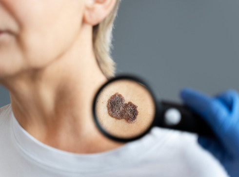 What is melanoma?