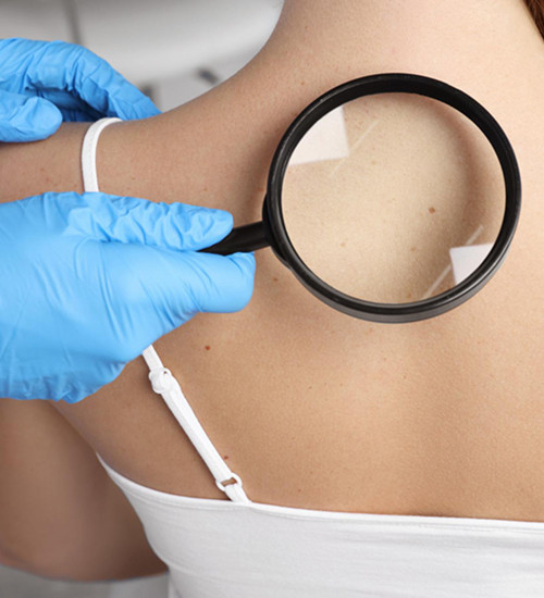 Palliative care goals for advanced melanoma