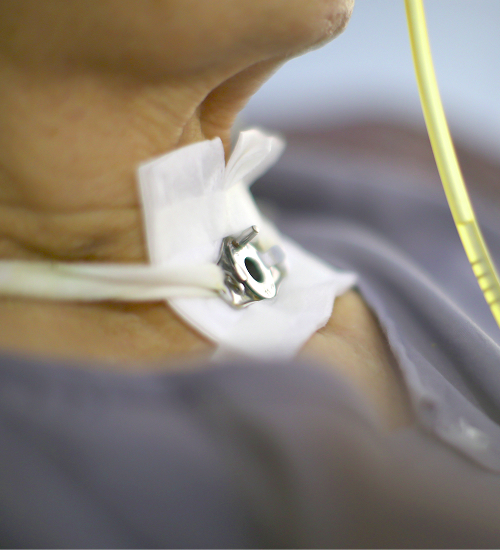 What is a tracheostomy and why is it necessary?