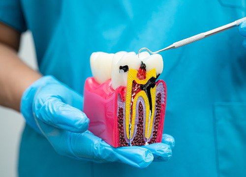 What is incipient caries?