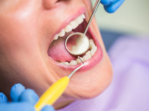 Dental Fluorosis Treatment in Moscow