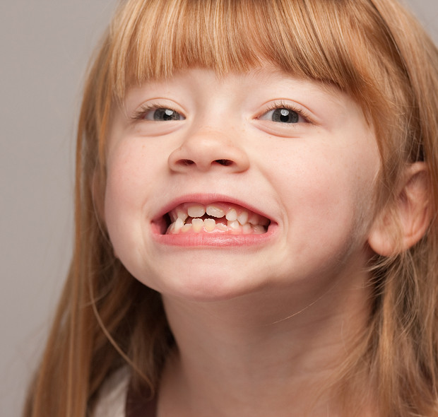 What is mesial occlusion?