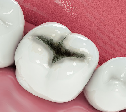 What is superficial caries?