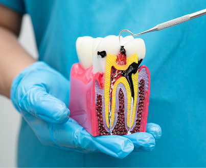 What is medium caries?