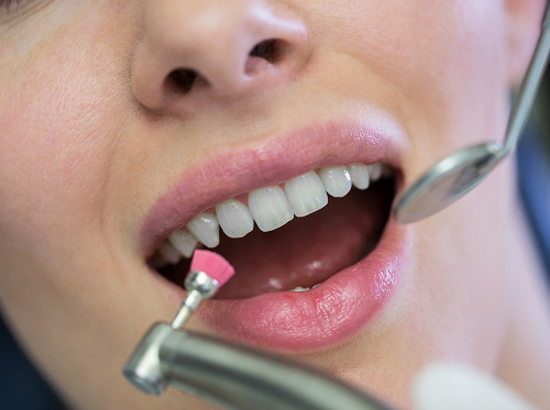 Preventing Moderate Caries