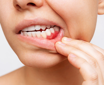 What is periostitis?
