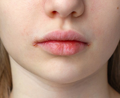 What is cheilitis?