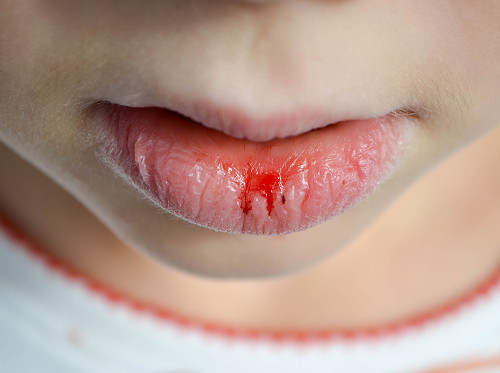 What are the dangers of untreated cheilitis?