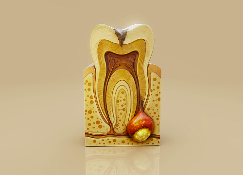 Что такое гранулема зуба