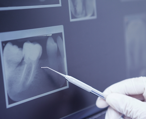 Диагностика гранулемы зуба