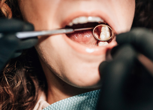 Symptoms of enamel erosion