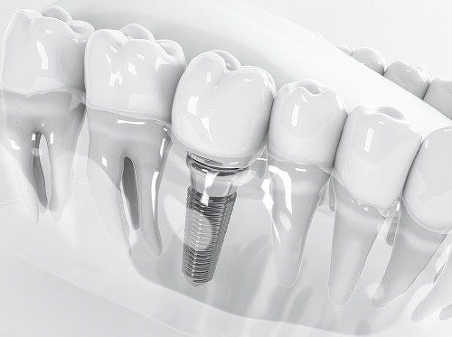 Treatment of Partial Adentia