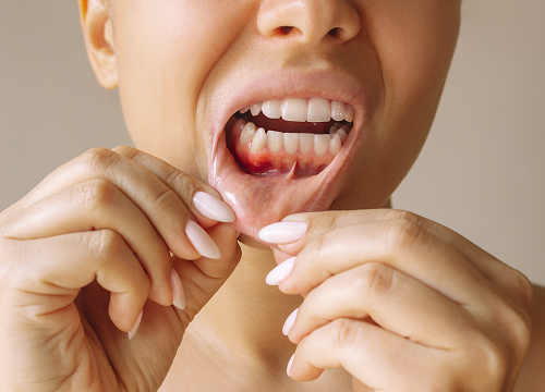 Что такое катаральный стоматит