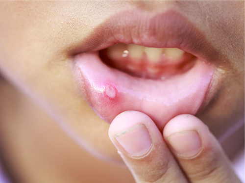 Что нельзя делать при афтозном стоматите