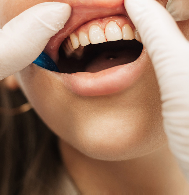 What do tetracycline teeth look like?