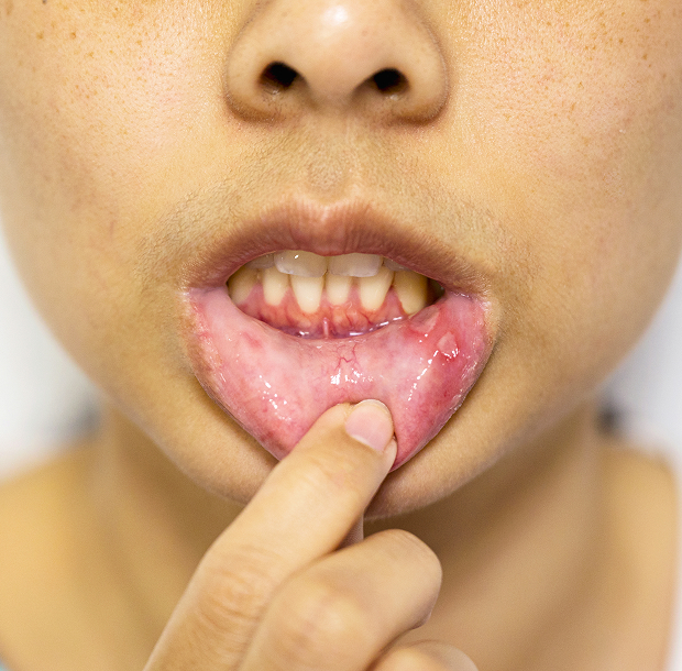 Симптомы герпетического стоматита