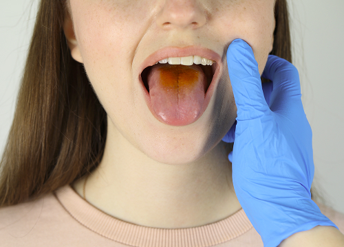 Что такое глоссит