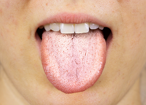 Что такое кандидоз