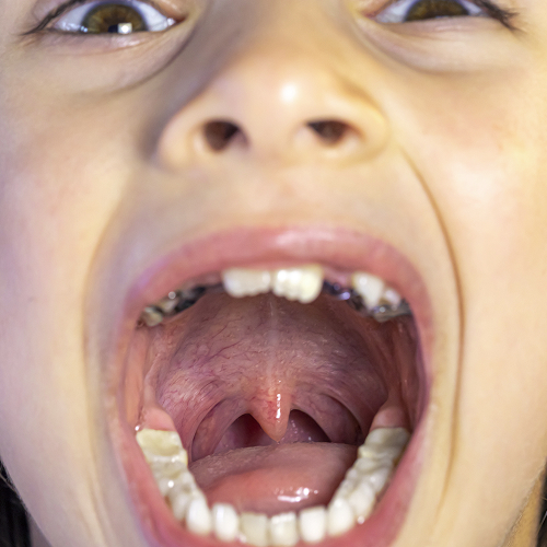 Что такое красный плоский лишай полости рта