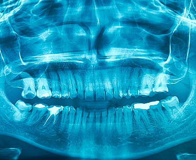 What is osteomyelitis of the jaw?