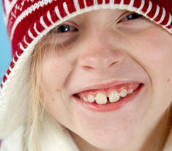 What is macrodontia?