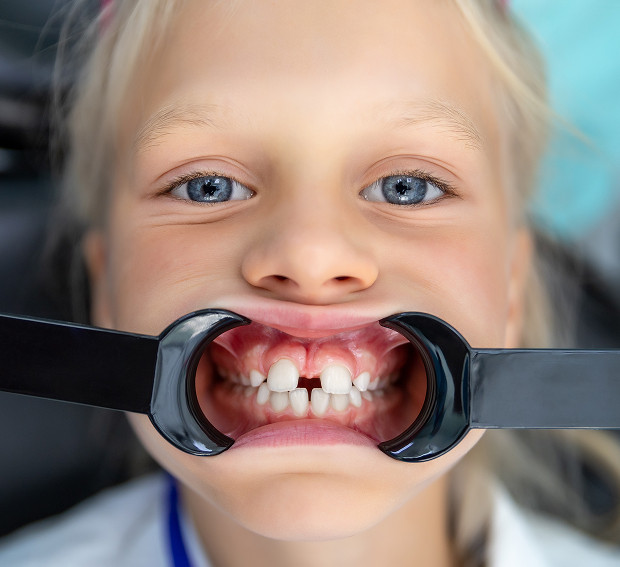 Causes of macrodontia