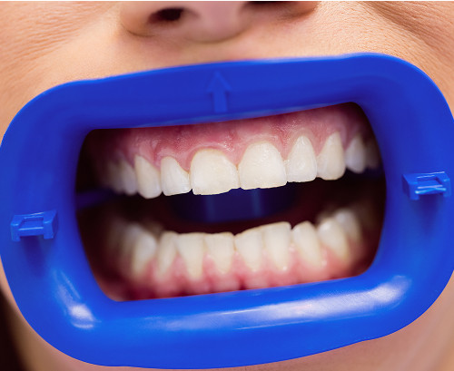 What are supernumerary teeth?