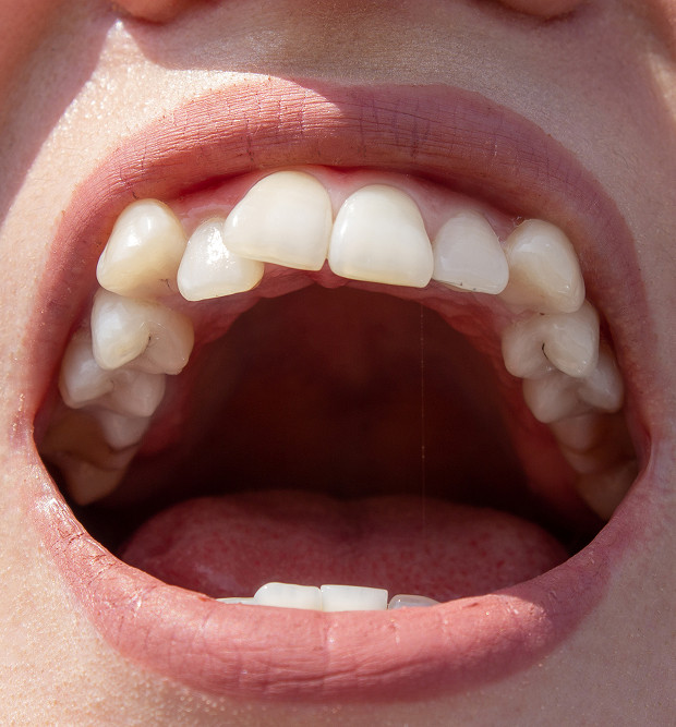 Symptoms of supernumerary teeth
