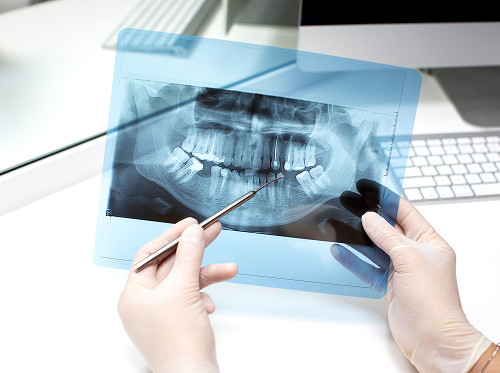Diagnosis of Supernumerary Teeth