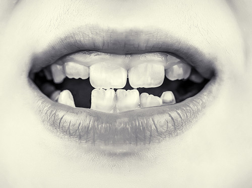 Supernumerary Teeth in Children