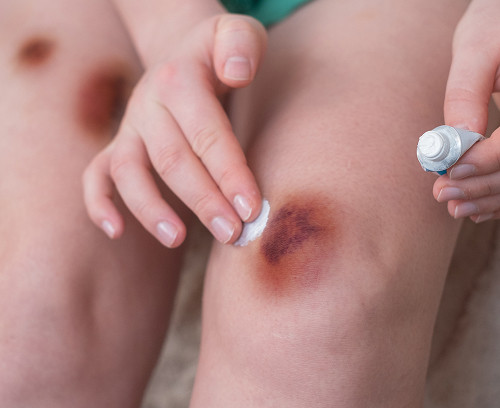 What is a subcutaneous hematoma in a child?