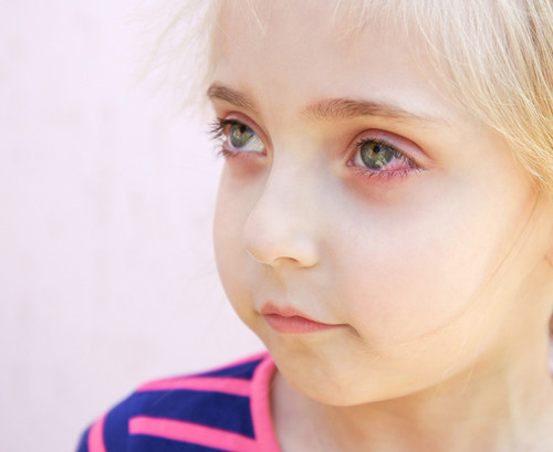What is an eye hematoma and how is it different from a regular bruise?