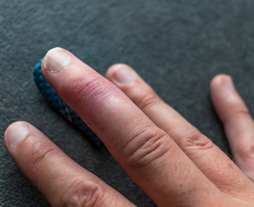 What is a hematoma on a finger?