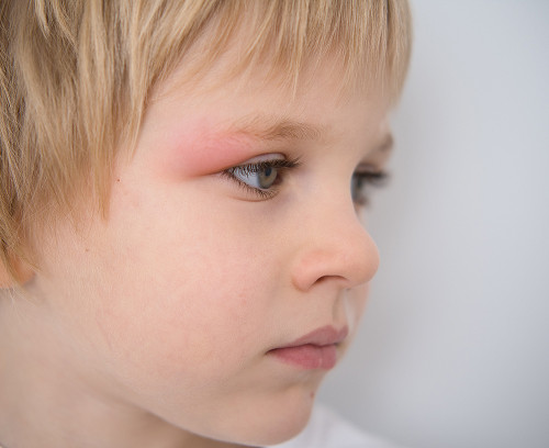How long does a hematoma take to heal in a child?