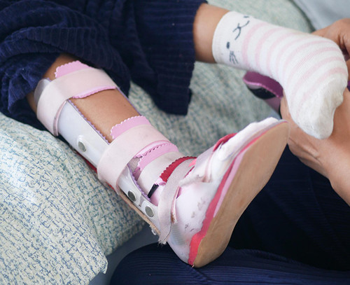 How is a tibial fracture treated in children?