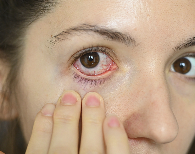 When is biomicroscopy prescribed?